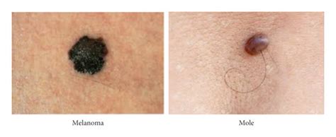 difference between mole and melanoma